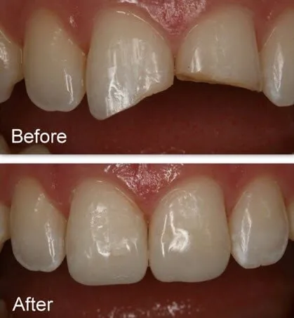 Before and after dental veneers showing improved tooth shape and alignment on front teeth.