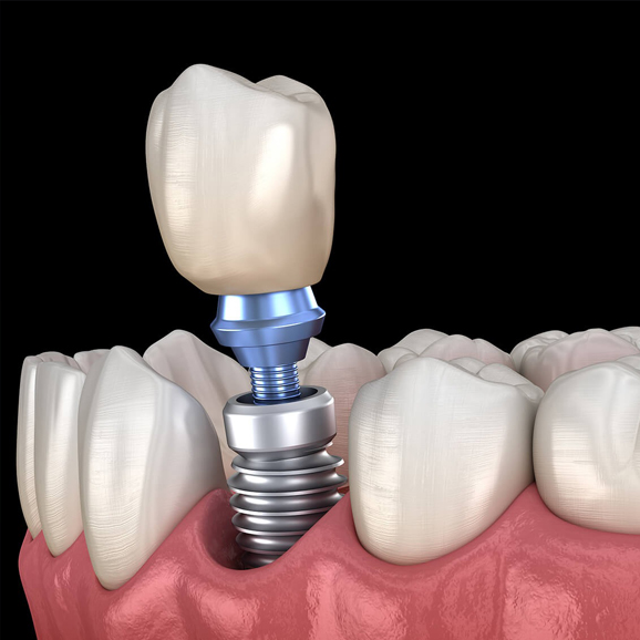 Dental implant diagram showing titanium screw and crown positioned between natural teeth in gum tissue.