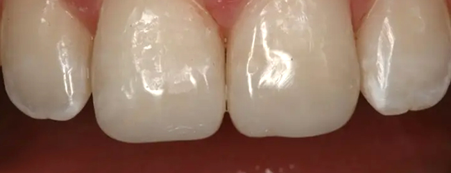 Four natural white teeth displayed against a dark red background showing dental work results.