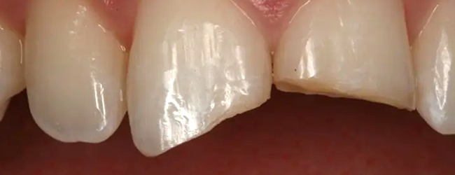 Close-up of front teeth showing dental work or tooth restoration in clinical setting.