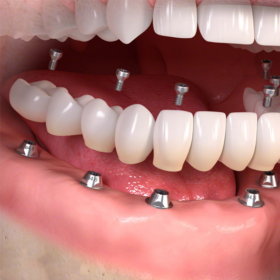 Dental implants with crowns installed in patient's jaw showing metal posts and ceramic tooth restorations.