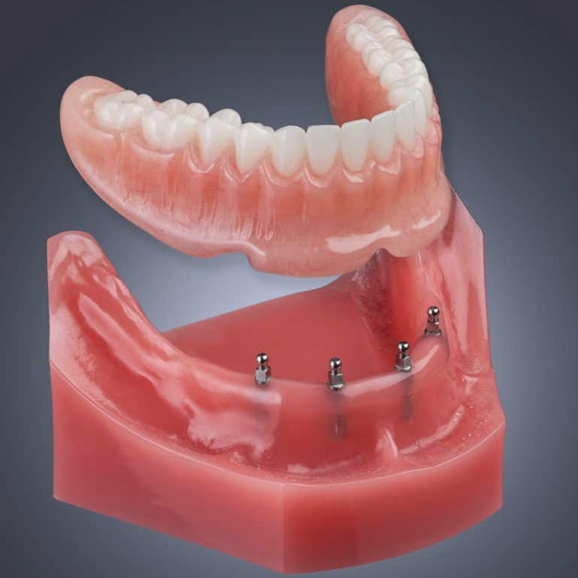 Dental implant model showing prosthetic teeth attached to jawbone with titanium posts.