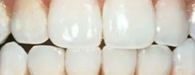 Close-up of upper and lower rows of white, healthy teeth showing dental alignment and brightness.