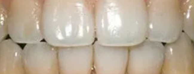 Close-up view of upper front teeth showing professional dental whitening or cosmetic dental treatment results.