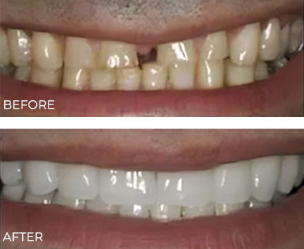 Before and after dental treatment showing improved tooth whitening and alignment at McMurray Family Dental.