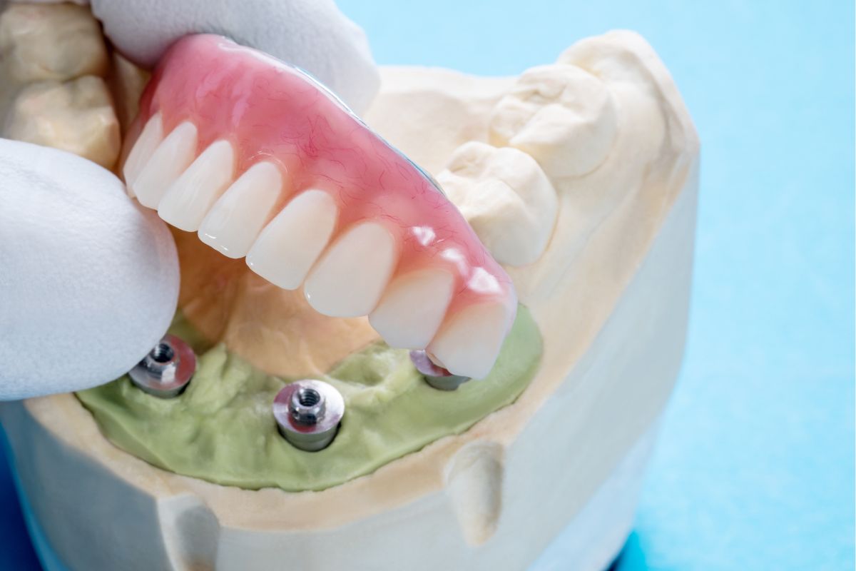 Dental Implants McMurray Family Dental